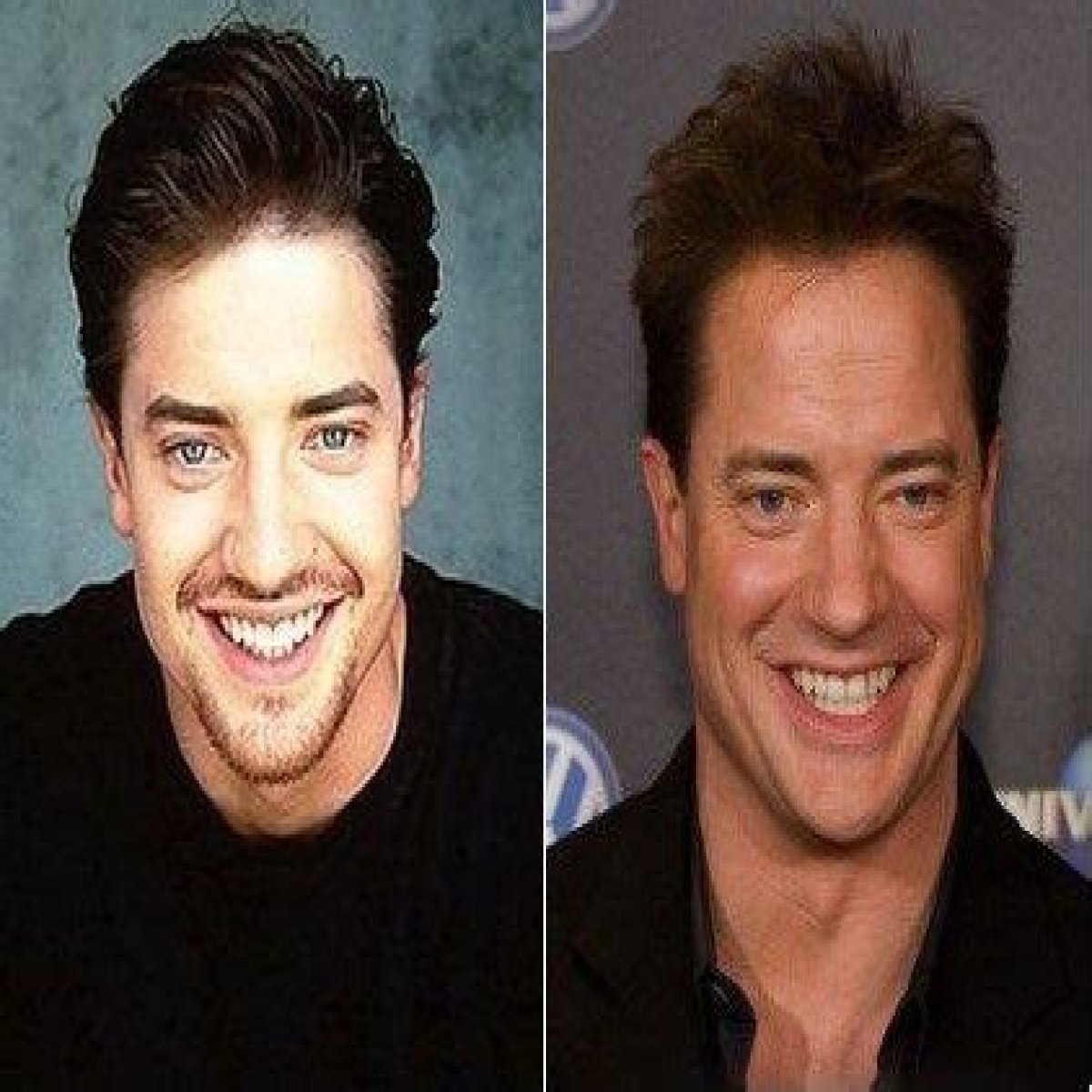 Brendan Fraser Plastic Surgery Before and After
