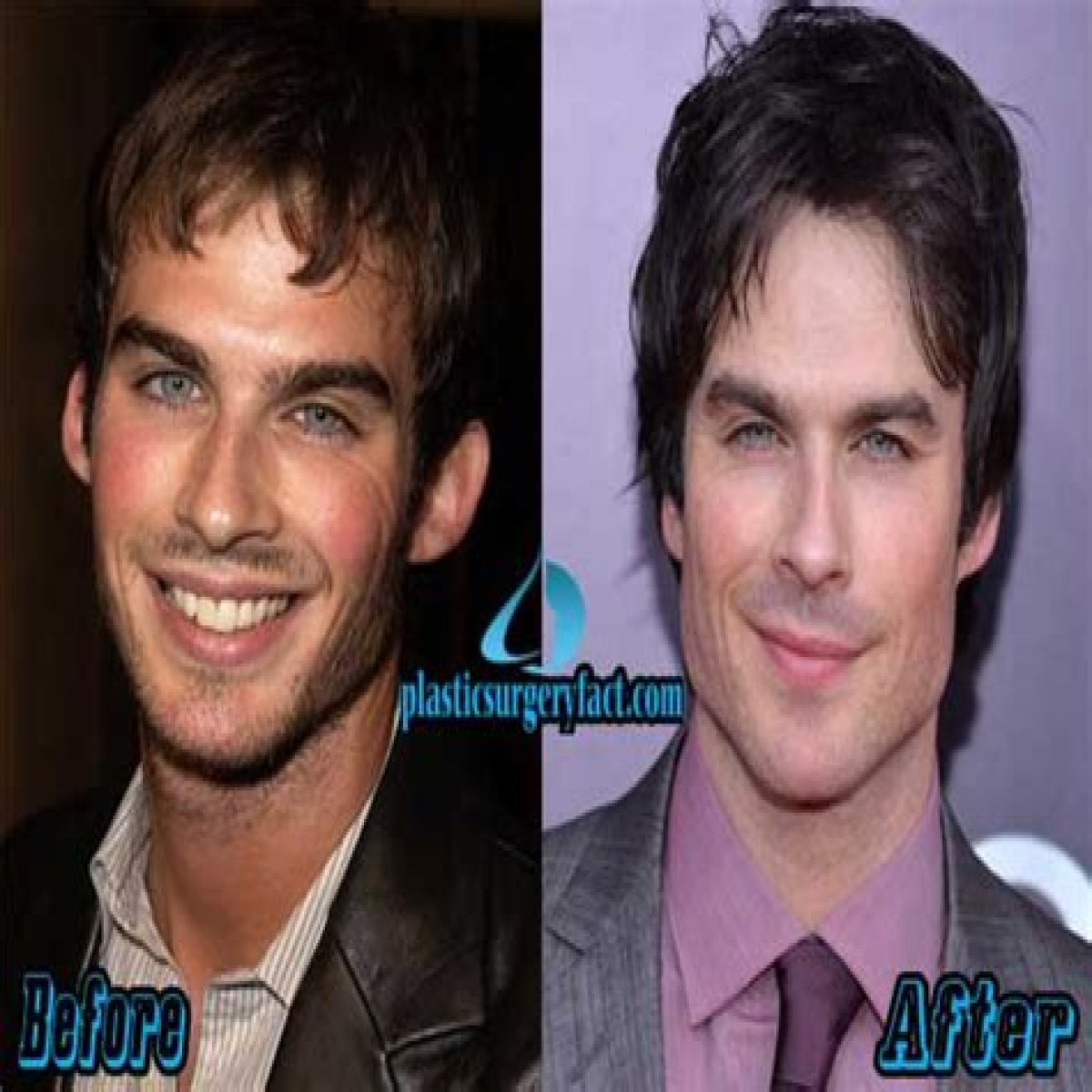 Ian Somerhalder Plastic Surgery Before and After