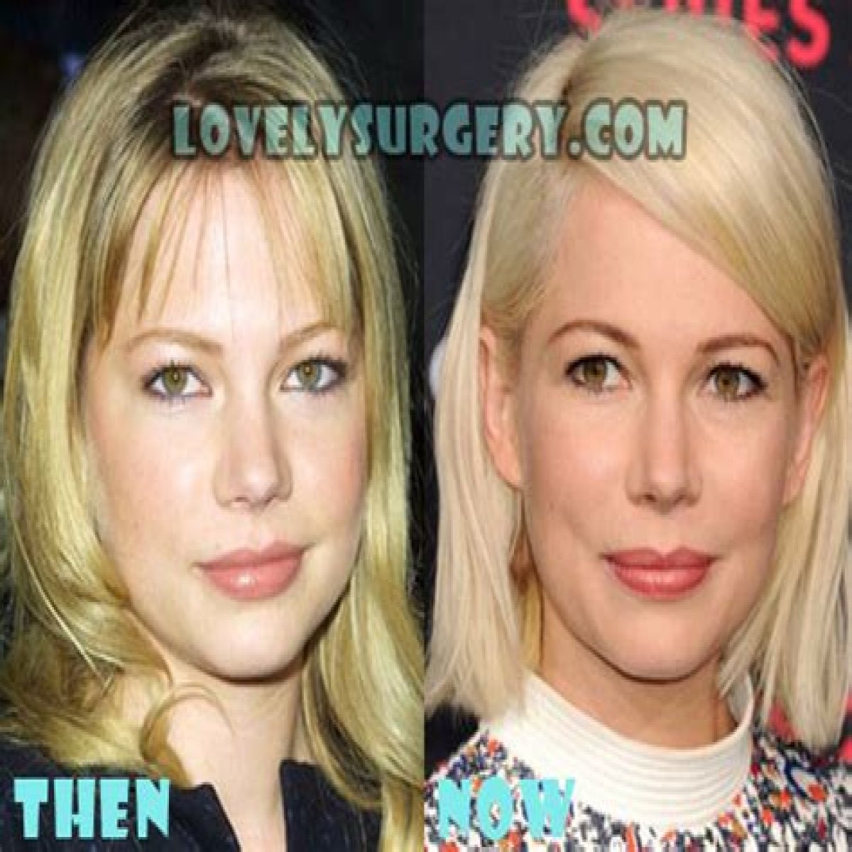 Michelle Williams Plastic Surgery Before and After