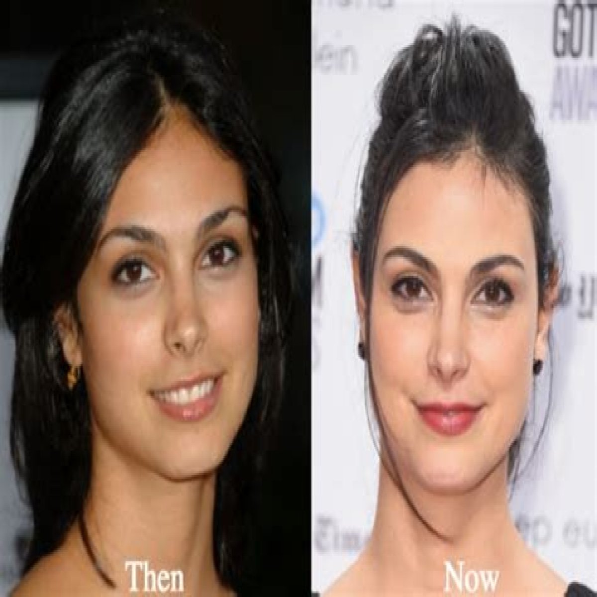Morena Baccarin Plastic Surgery Before and After